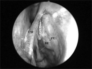 Left nasal cavity endoscopy showing the flexible plastic tube emerging from the middle meatus (CM = middle turbinate; PU = unciform process; BE = ethmoidal bulla).