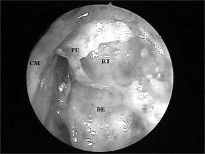 Left nasal cavity endoscopy with 4mm 45o rigid endoscope showing the terminal recess that impairs the direct frontal sinus ostium visualization;