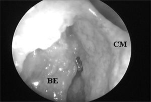 Right side nasal cavity endoscopy with 4mm 45o rigid endoscope showing the ethmoidal bulla impairing the endonasal visualization of the frontal sinus ostium;