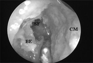 Ethmoidal bulla superior portion exeresis and consequent frontal sinus ostium visualization when catheterized by the flexible plastic tube (CM = middle turbinate; BE = ethmoidal bulla; SF = frontal sinus).