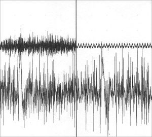 Left thyroarytenoid muscle electromyography. Upper trace: vocal emission sound captured by a microphone. Lower trace: electrical potentials captured from the muscle by means of a concentric monopolar needle. Left image: during phonation. Right side image: during inspiration.