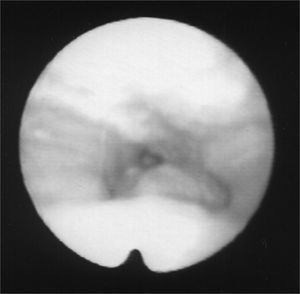 Palate after Botox injection; pharynx contracted during inspiration