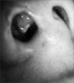 Nostril and nose vestibule with a yellow-grayish burn surrounded by erythema.