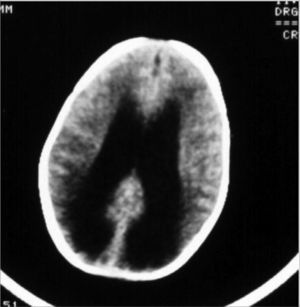 Important hydrocephaly seen by means of computerized tomography.