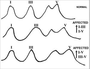 Examples of BERA traces inter-peak intervals in retrocochlear lesions.