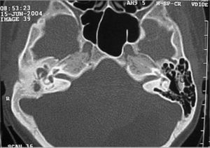 Middle ear papilloma - Post-op CT scan