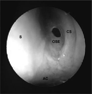 Ostium of the left sphenoidal sinus. AC - Choanal arch, S - Nasal septum, CS - Superior turbinate, OSE - Ostium of the sphenoidsl sinus.