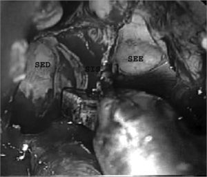 Removal of the intersinus septum. SES - Left sphenoidal sinus. SED - Right sphenoidal sinus. SIS - Intersinus septum.