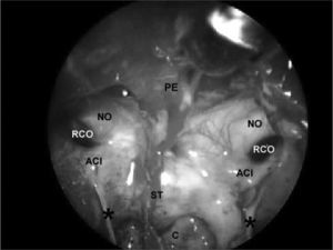Sphenoidal sinus after partial removal of the intersinus septum. PE - Sphenoidal plane. NO - Optic nerve, ACI - Internal carotid artery, RCO - Carotid-optic recess, ST - Sella turcica, C - clivus, * - incomplete septa within the sphenoidal sinus.