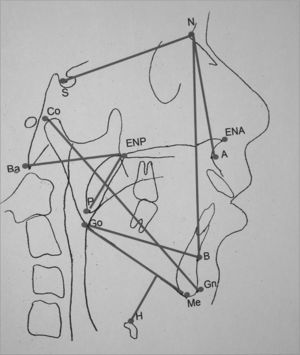 Cephalometric measures of dentofacial morphology and pharyngeal air space. Posterior Air Space (PAS)- Distance between the tongue base and the posterior pharyngeal wall, determined by the B-Go line. Distance Hyoid-mandibular plane - distance from the H point - anterior and superior most point of the hyoid bone all the way to the mandibular plane (Me-Go), through a line perpendicular to it. Soft Palate Length - Distance between the ENP-P Ba-ENP points-Bony pharynx size. Distance between the Ba-ENP points Mandibular length (Co-Gn)- Distance between the condylar point and the gnathion in mm. SNA- Antero-posterior maxilla position in relation to the skull base. Angle formed by the S-N and N-A lines. SNB- antero-posterior mandible position in relation to the skull base. Angle formed by the S-N and N-B lines.