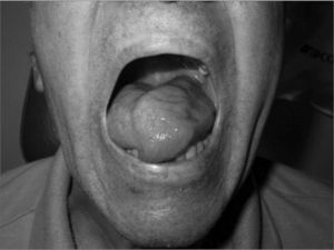 Tongue protrusion attempt with an infection in the retropharyngeal area.