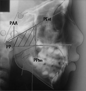 Planes that define the trapezoid used to calculate the nasopharynx area: palatal plane (PP), sphenoidal plane (Pesf), plane going through AA (PAA) and plane going through ENP (PPtm).