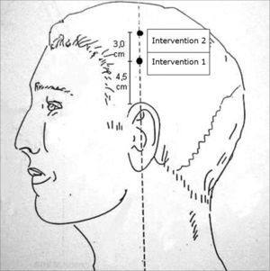 Acupuncture points used in both groups - Intervention 2 / Intervention 1