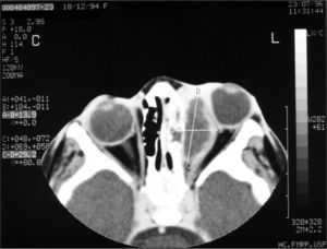 Axial view CT scan of the orbit showing subperiosteal abscess on the left side.
