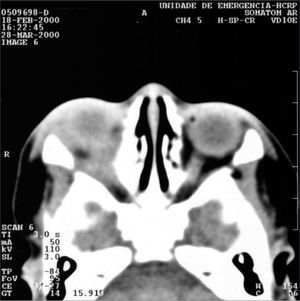 Axial view CT scan of the orbit showing orbitary abscess on the right side.