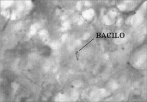 ZIEHL 1000X: Histopathology for BAAR search, showing microorganisms with structures matching those of the Koch’s Bacillus.