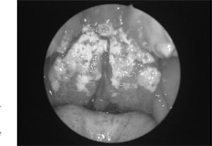 Endoscopy of the right nasal fossa showing perforation of the anterior nasal septum (*) and a granulomatous lesion involving the mucosa in the anterior nasal septum, the tip of the lower turbinate and the floor of the nasal fossa (CI = lower turbinate; Se = septum).