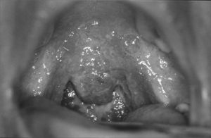 Granulomatous infiltrate in the oropharynx.