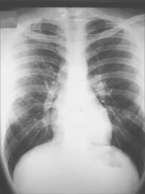 Normal chest x-ray.