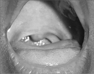 Oropharynx after treatment.