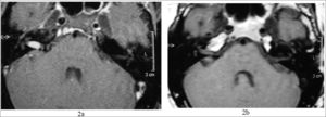 2a) MRI with gadolinium at the time of diagnosis; 2b) 4 years later, notice tumor involution.