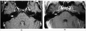 4 a) MRI with gadolinium at the time of diagnosis; 4b) after two years.