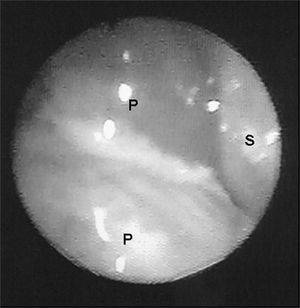 Endoscopic image of a grade III polyp in the right nasal cavity of patient #1. P - polyp S - nasal septum