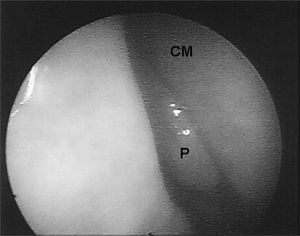 Endoscopic image of a grade I nasal polyp in the right nasal cavity of patient # 7. - P - polyp CM - middle turbinate