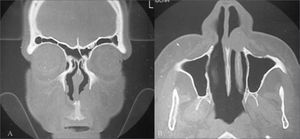 Radiological findings (computed tomography) of a nasolabial cyst – coronal section (A) and axial section (B) of a left unilateral cyst.