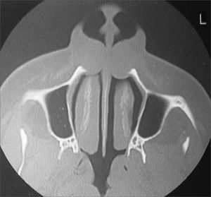 Radiological findings (computed tomography) of a nasolabial cyst – axial section of bilateral cysts.