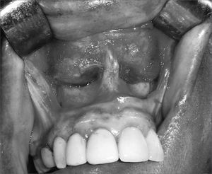Sublabial approach for resecting a bilateral nasolabial cyst, remodeling of the lower ridge of the piriform opening may be seen.
