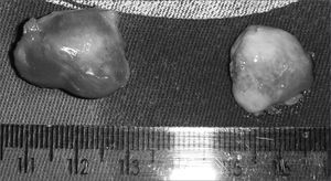 Aspect of a bilateral nasolabial cyst after surgical enucleation.