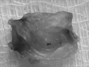 Temporal bone após descalcificação e corte transversal - TM: tympanic membrane. Note the middle ear with no macroscopically observable cholesteatoma.