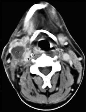 axial CT with endovenous contrast. – high jugular-carotid (level II) lymph node block (BL) to the left with a contact interface below 50% of the internal carotid artery circumference. CI: internal carotid artery; CE: external carotid artery.