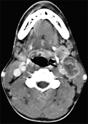 axial CT (4 sequential sections) with endovenous contrast. High jugular-carotid (level II) lymph node block (BL) to the left with signs of rupture of the capsule and a contact interface over 50% of the internal carotid artery circumference (arrow).