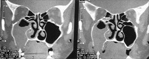 Opacification and erosion of the lower maxillary sinus bone wall.
