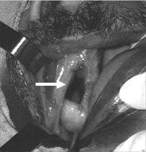 Ample fistula measuring over 1 cm following tooth extraction.