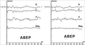 Extratympanic electrocochleography in auditory neuropathy/dyssynchrony - ABEP recordings in AN/AD