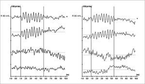 Extratympanic electrocochleography in auditory neuropathy/dyssynchrony - ET-ECoG recordings in AN/AD