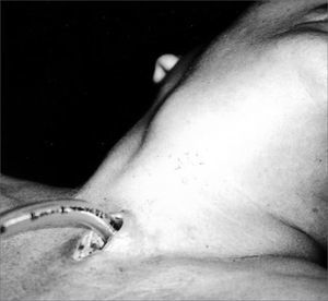 Laryngocele