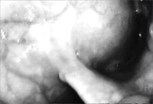 Laryngocele's internal part. Videolaryngoscopy showing the tumor occluding the laryngeal vestibule, hiding the piriform sinus.