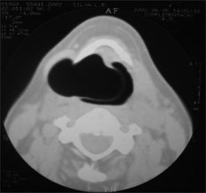 Larynx CT scan showing the laryngocele.