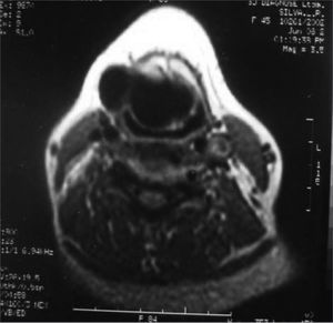 MRI showing the laryngocele in details.