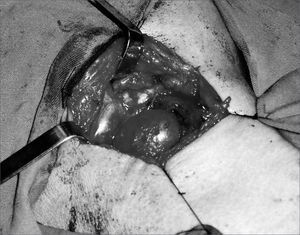 Lesion removal by an external approach.