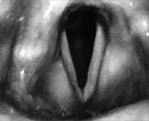 Postoperative Video-laryngoscopy.