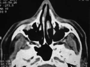 Postoperative CT: complete removal of the lesion.