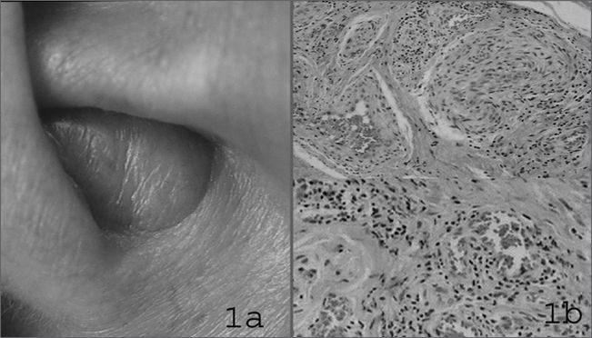 Angiolymphoid hyperplasia with eosinophilia: excellent response to ...