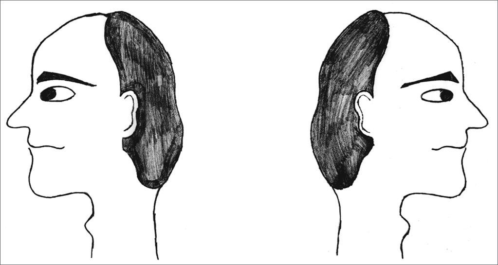 Vestibular rehabilitation's effect over the quality of life of ...