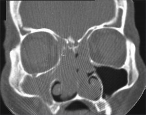 Nasal cavity and paranasal sinuses CT scan. Coronal cross-section, showing the bilateral involvement of nasal cavities, ethmoidal sinuses and right maxillary sinus.
