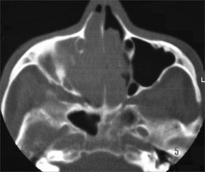 Nasal cavity and paranasal sinuses CT scan. Axial cross-section, showing bilateral involvement of the nasal cavities and right maxillary sinus.